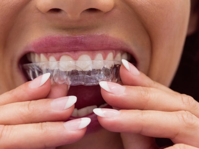 Why Invisalign Might Be the Right Choice for Your Smile